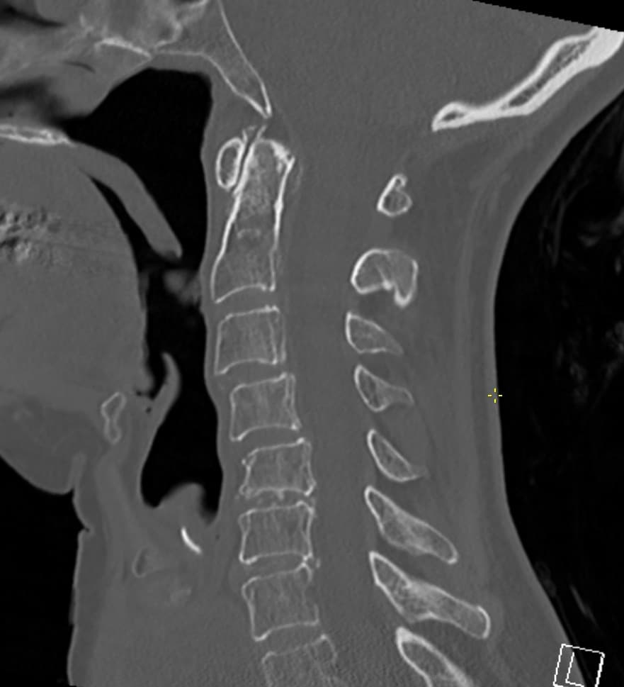 CT fracture reassessment: key checkpoints